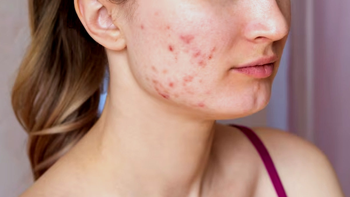 Unmasking the Culprit: Demystifying Hormonal Acne – Femisafe.in