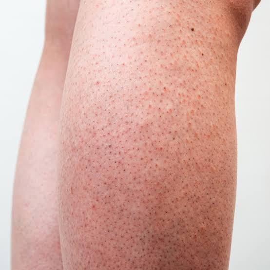 Strawberry Legs: Causes, Prevention, and Treatment Tips – Femisafe.in