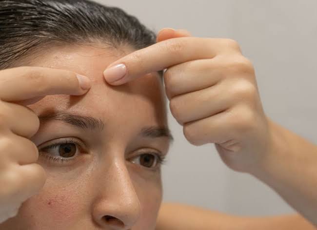 demystifying-forehead-pimples-causes-prevention-and-treatment